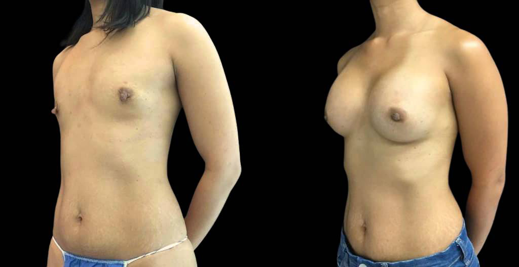 33-year-old-female-nipple-reduction-before-and-after-three-quarter-view.jpg