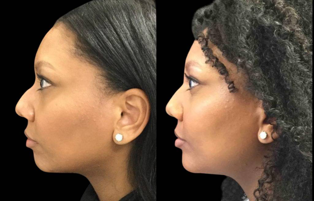 33-year-old-female-non-surgical-chin-augmentation-before-and-after-side-view.jpg