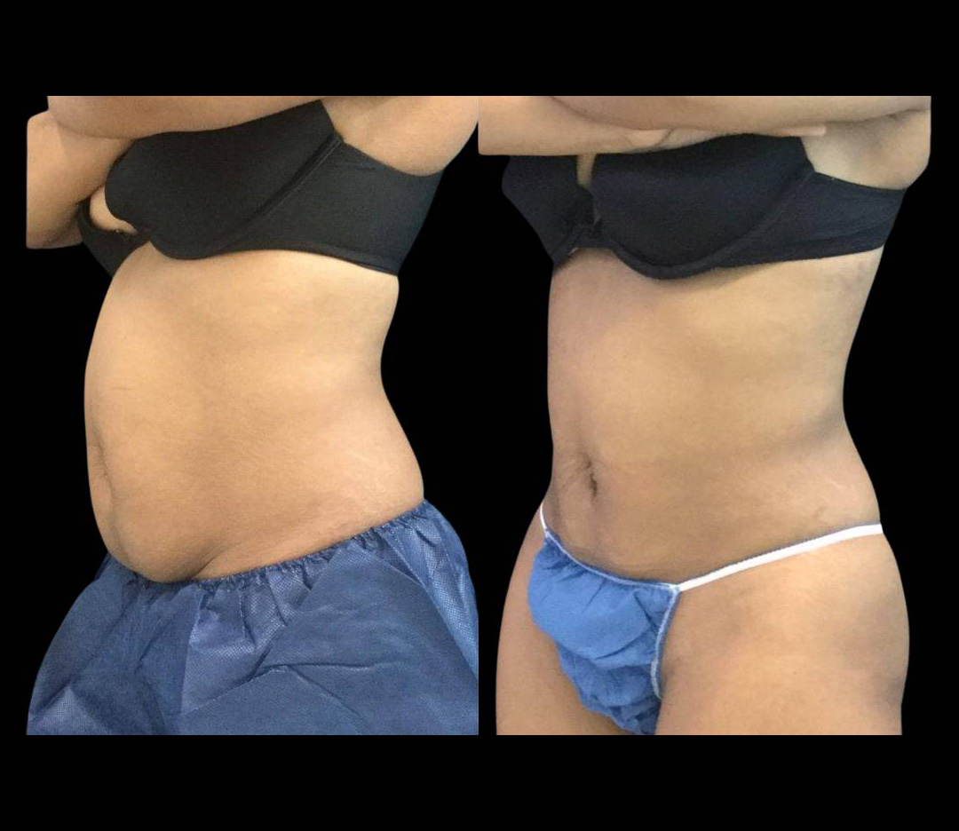 33-year-old-female-non-surgical-tummy-tuck-before-and-after.jpg