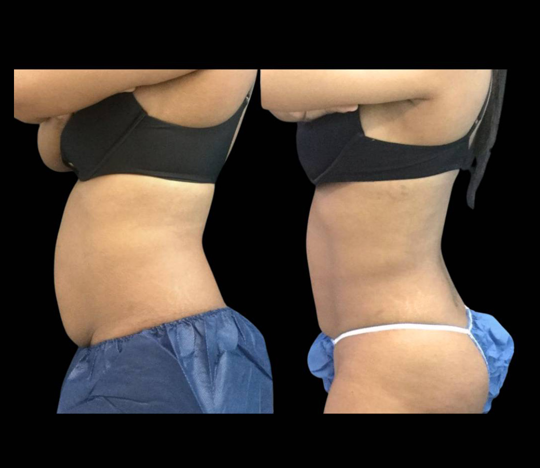 33-year-old-female-non-surgical-tummy-tuck-before-and-after-2.jpg