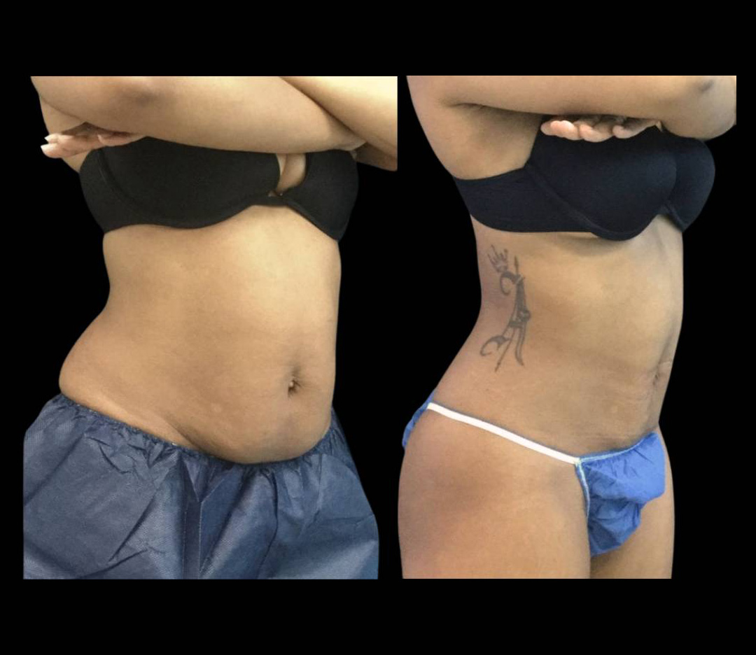 33-year-old-female-non-surgical-tummy-tuck-before-and-after-3.jpg