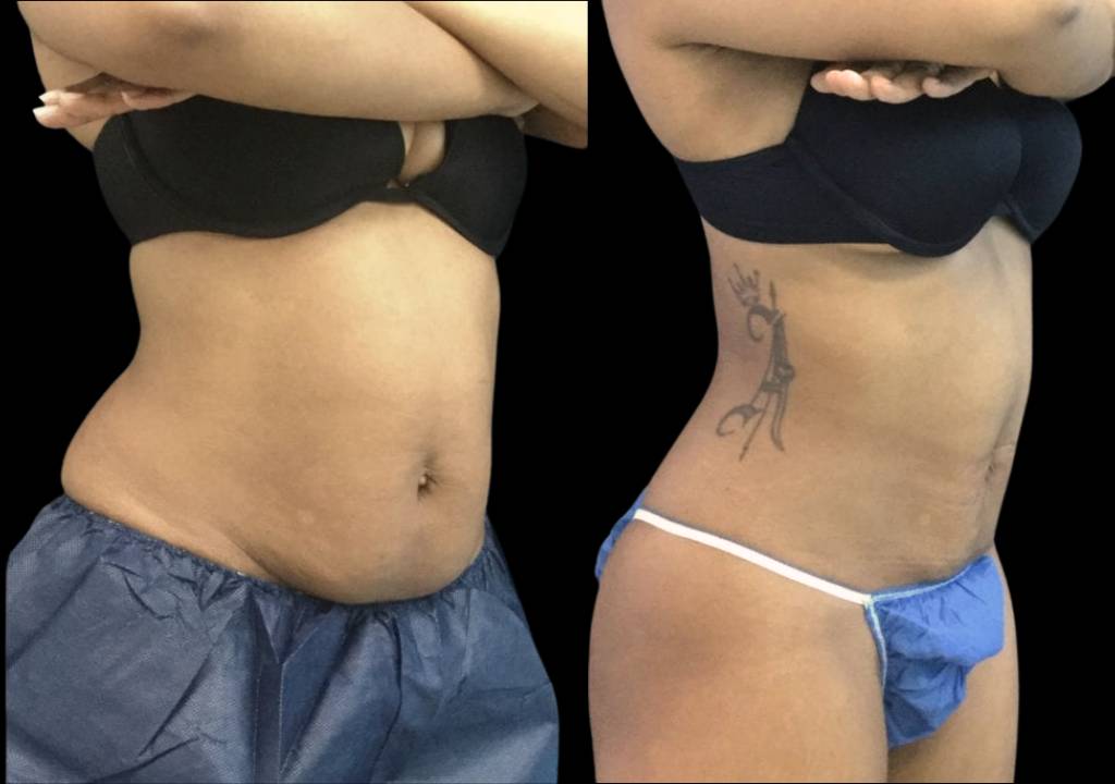 33-year-old-female-non-surgical-tummy-tuck-before-and-after-3
