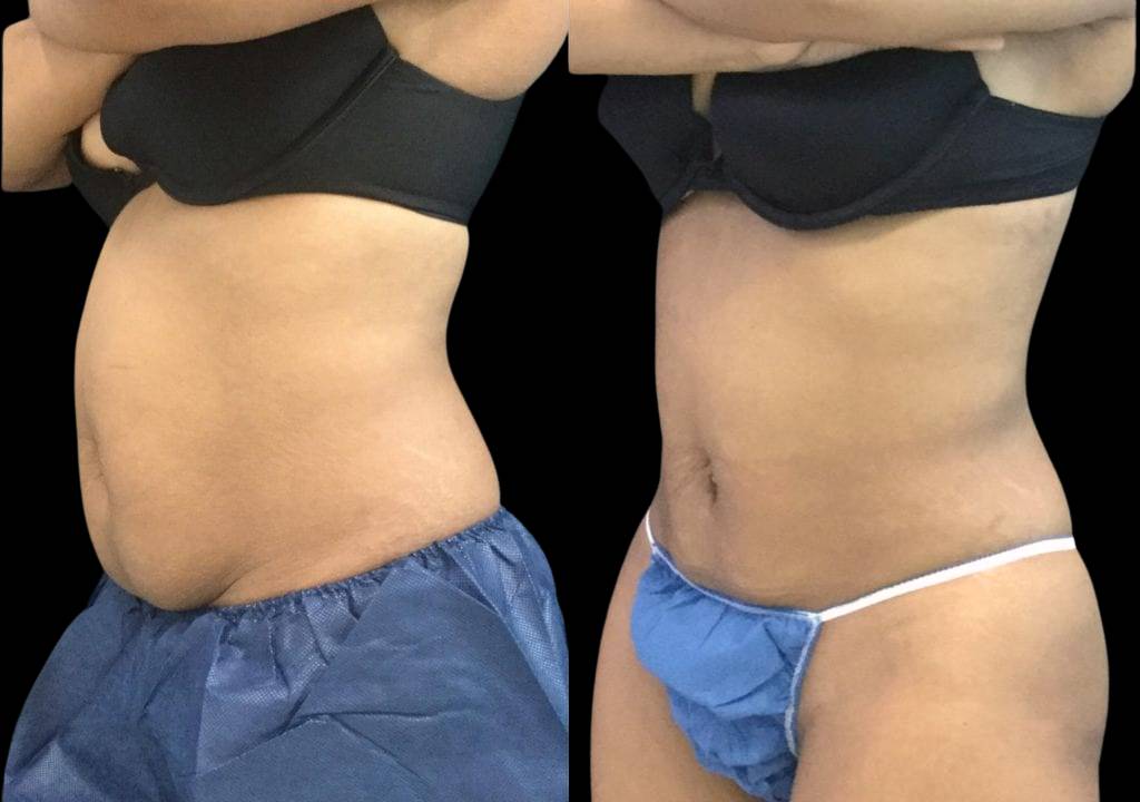 33-year-old-female-non-surgical-tummy-tuck-before-and-after
