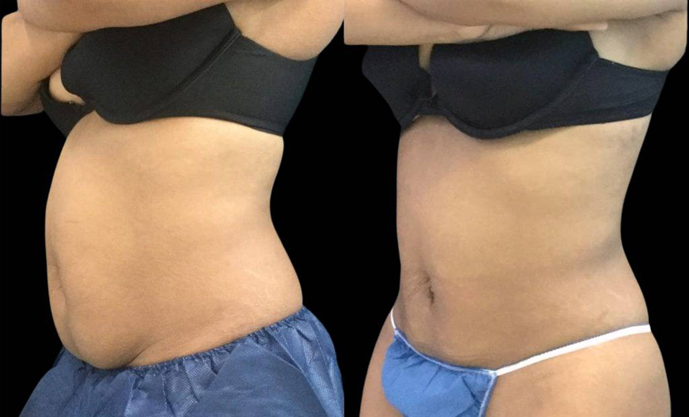 33-year-old-female-non-surgical-tummy-tuck-before-and-after.jpg