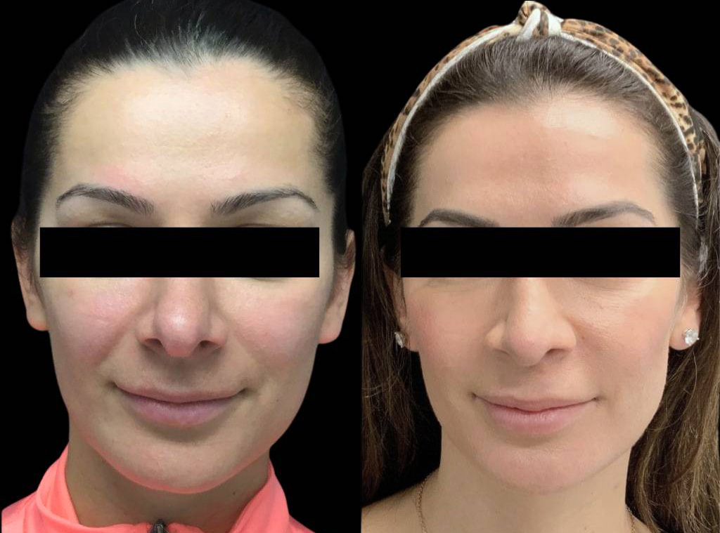 33-year-old-female-rhinoplasty-before-and-after-front-view-2-1.jpg