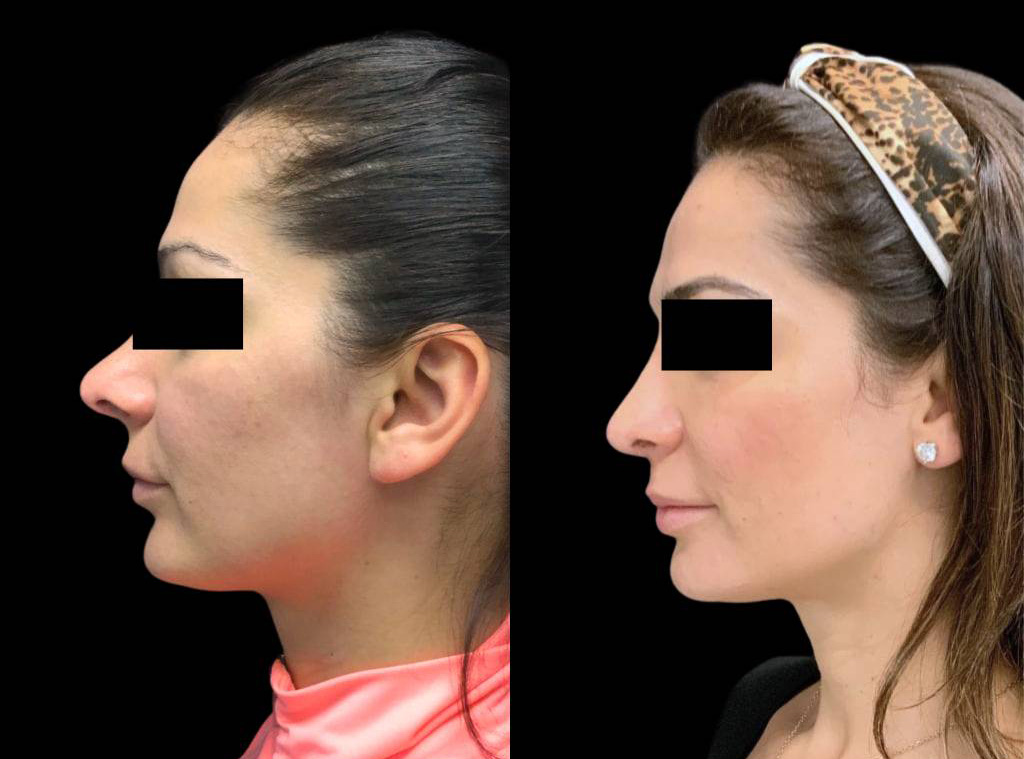 33-year-old-female-rhinoplasty-before-and-after-side-view-2-2.jpg