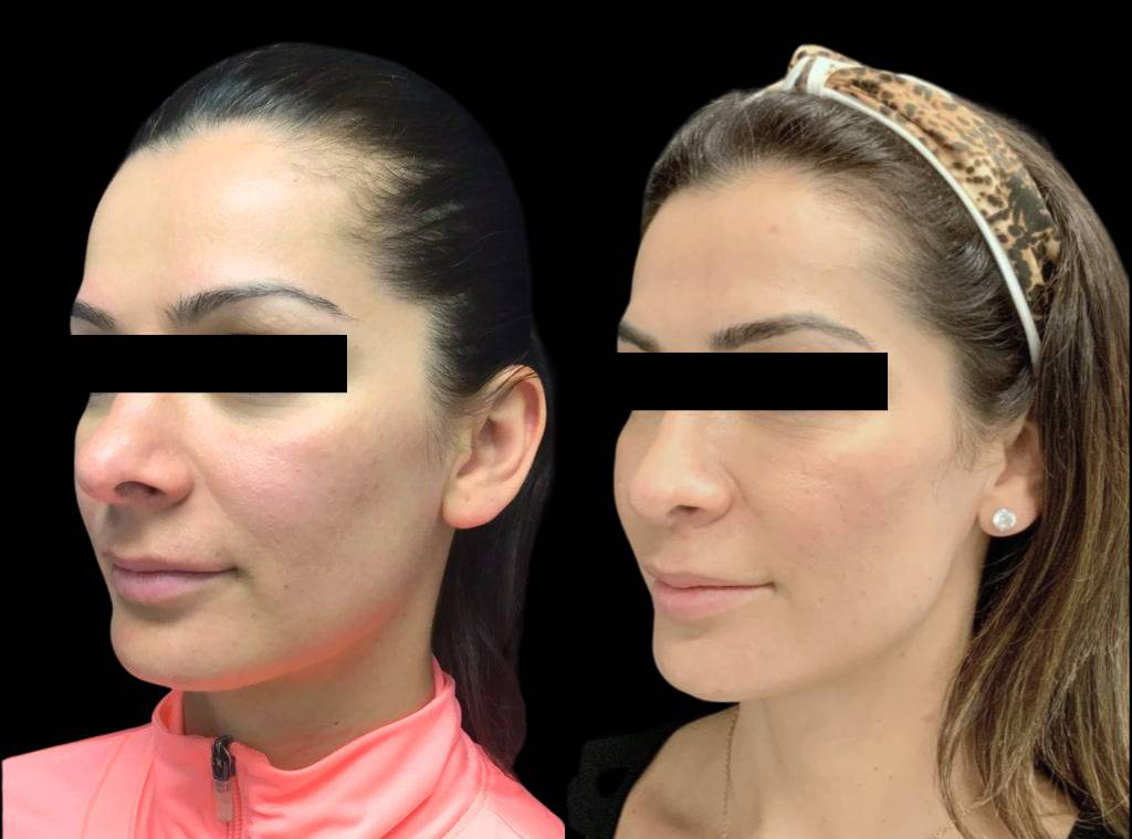 33-year-old-female-rhinoplasty-before-and-after-three-quarters-view-3-1.jpg