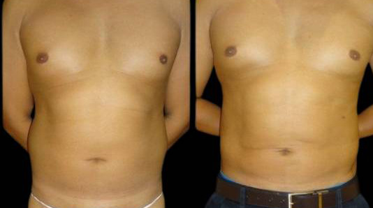 This is a 33-year-old male that has had an abdominal etching done showing the before and after's side-by-side