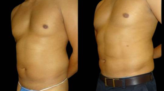 This is a 33-year-old male that has had an abdominal etching done showing the before and after's side-by-side