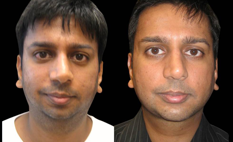 33-year-old-male-chin-implant-before-and-after-front-view-.jpg