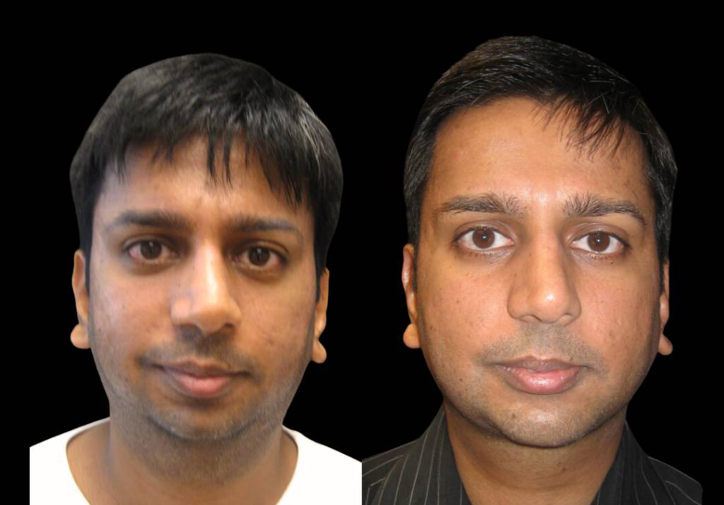 33-year-old-male-chin-implant-before-and-after-front-view-.jpg
