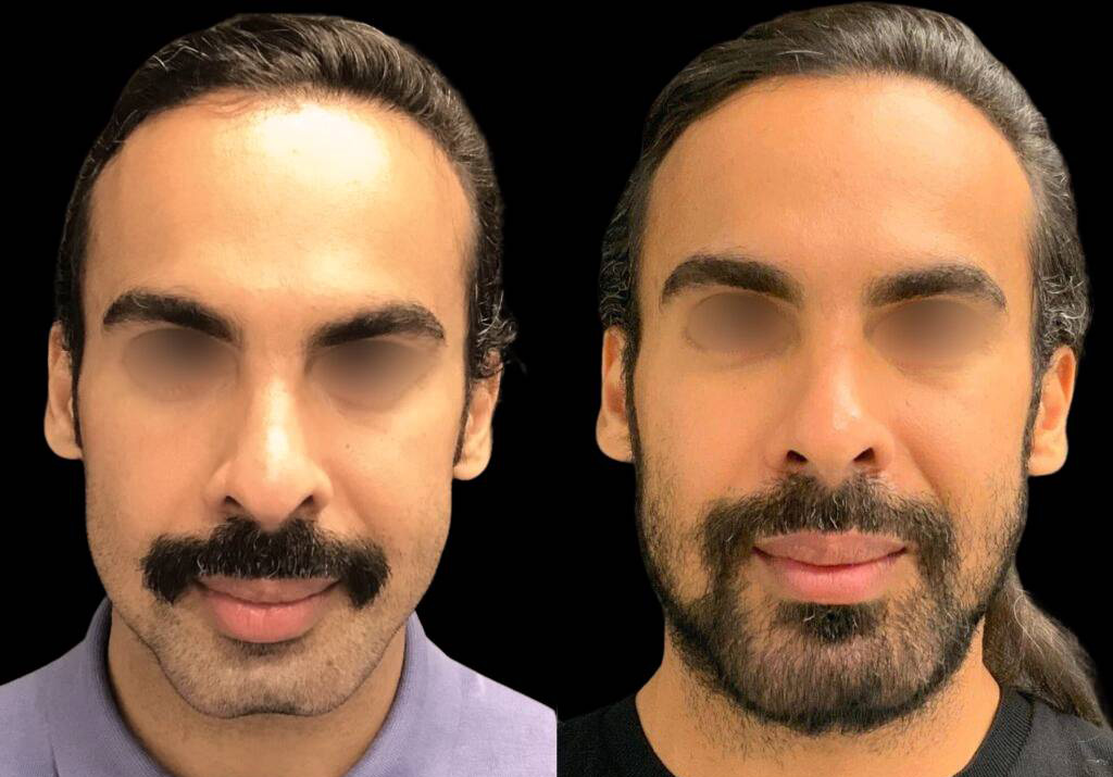 33-year-old-male-chin-implant-before-and-after-front-view-33888.jpg