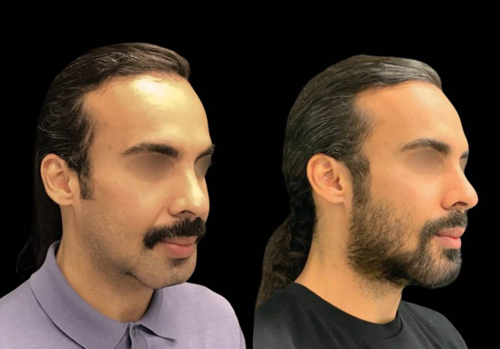 33-year-old-male-chin-implant-before-and-after-front-view.jpg