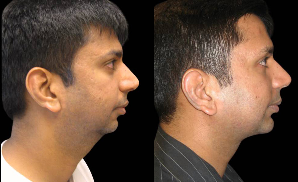 33-year-old-male-chin-implant-before-and-after-side-view-.jpg