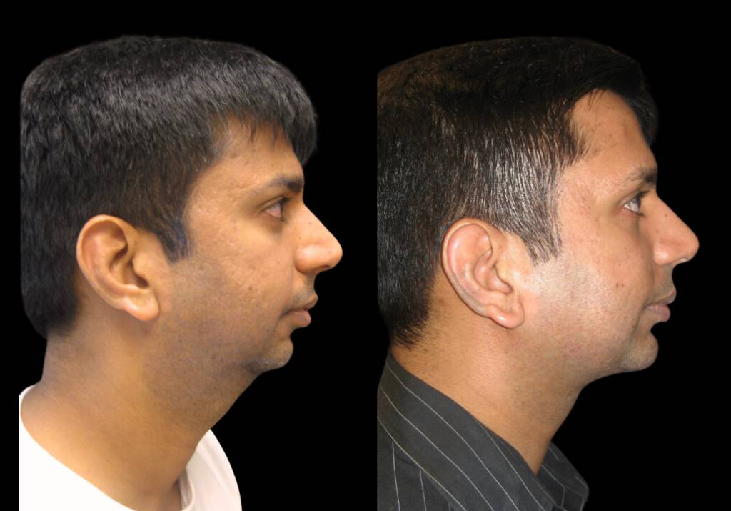 33-year-old-male-chin-implant-before-and-after-side-view-.jpg