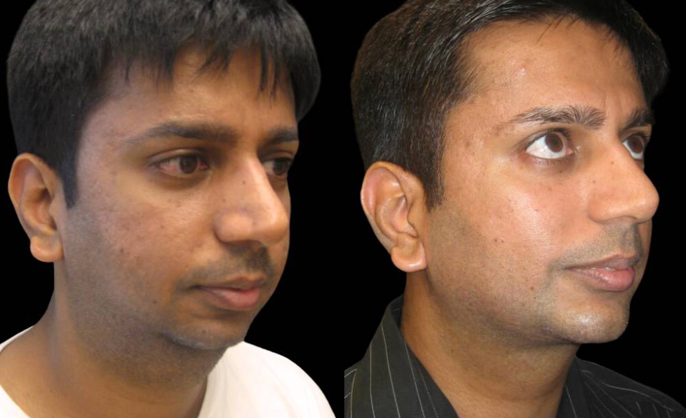 33-year-old-male-chin-implant-before-and-after-three-quarter-view-.jpg