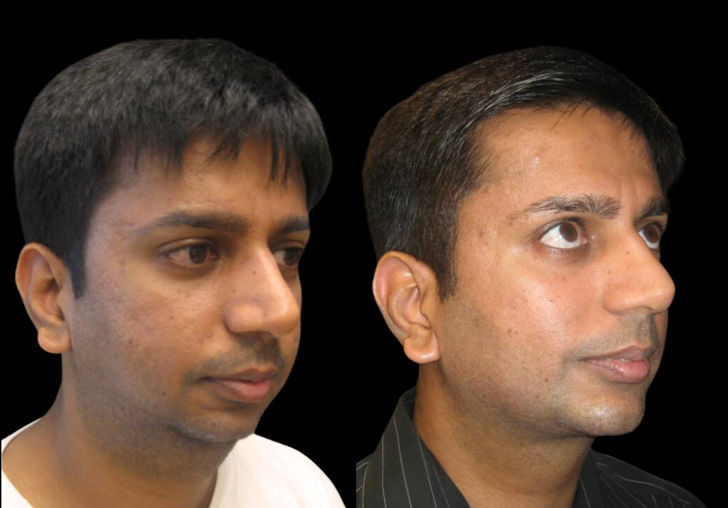 33-year-old-male-chin-implant-before-and-after-three-quarter-view-.jpg