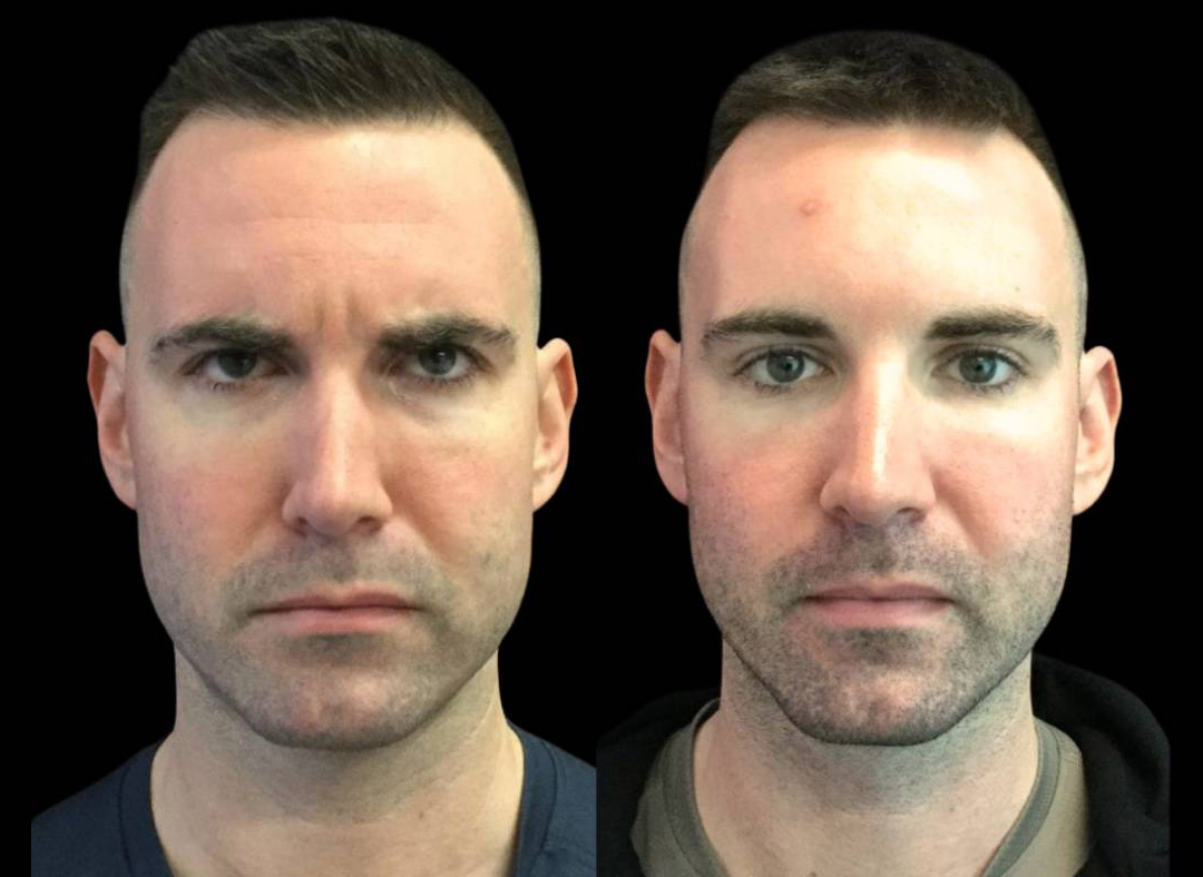 33-year-old-male-dysport-before-and-after-front-view-12106.jpg
