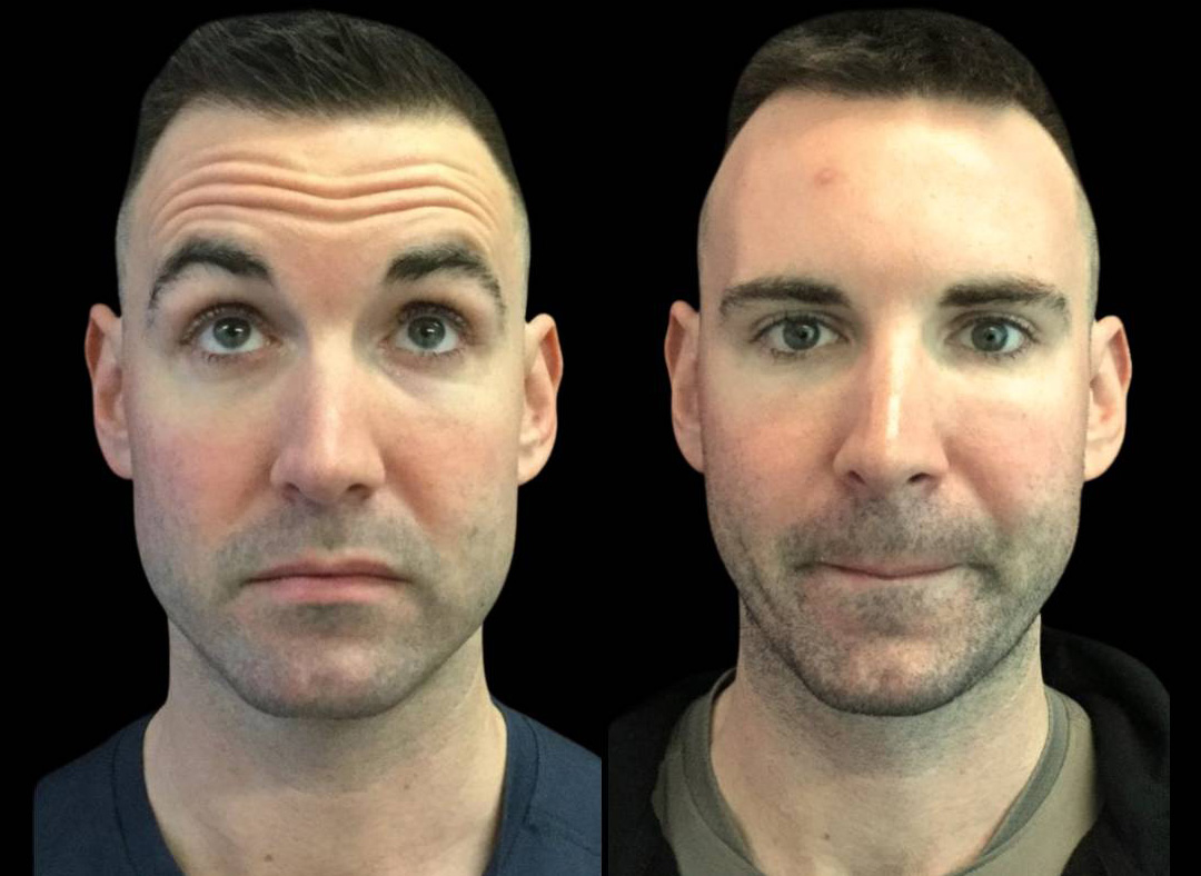 33-year-old-male-dysport-before-and-after-front-view.jpg