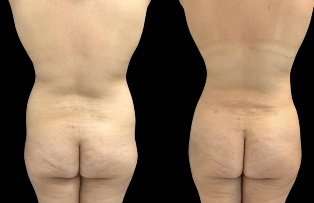 This is a 34-year-old female that has had a brazilian butt lift showing the before and after's side-by-side