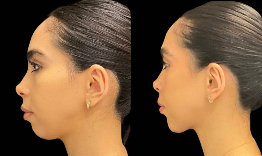 34-year-old-female-chin-implant-before-and-after-side-view.jpg