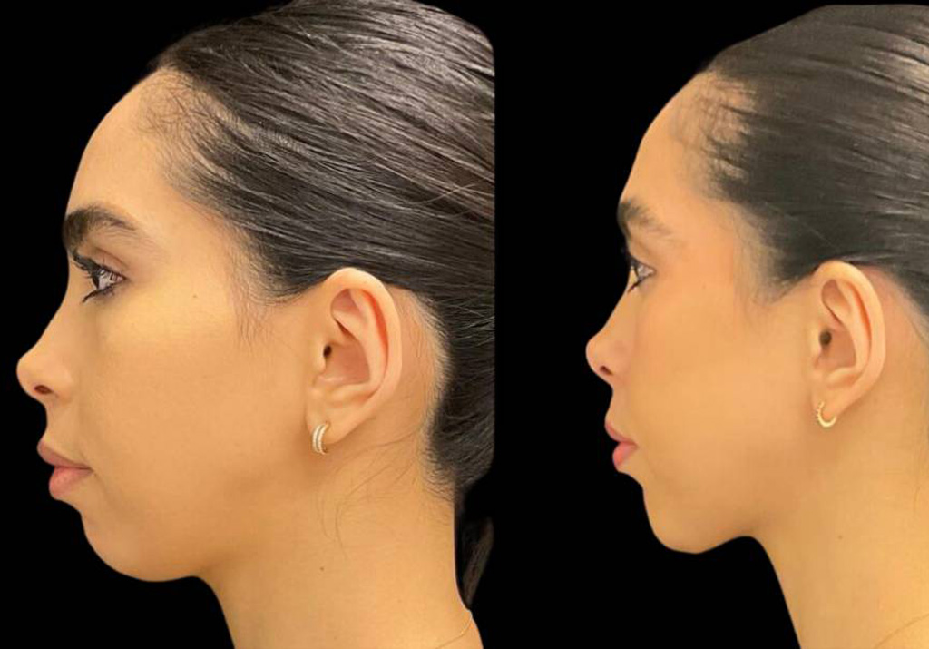 34-year-old-female-chin-implant-before-and-after-side-view.jpg
