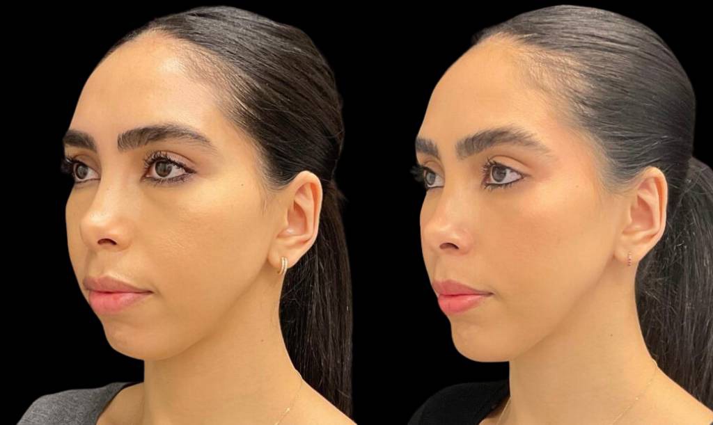 34-year-old-female-chin-implant-before-and-after-three-quarter-view.jpg
