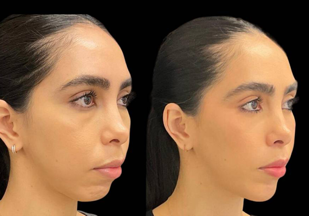 34-year-old-female-chin-implant-before-and-after-three-quarter-view-1.jpg