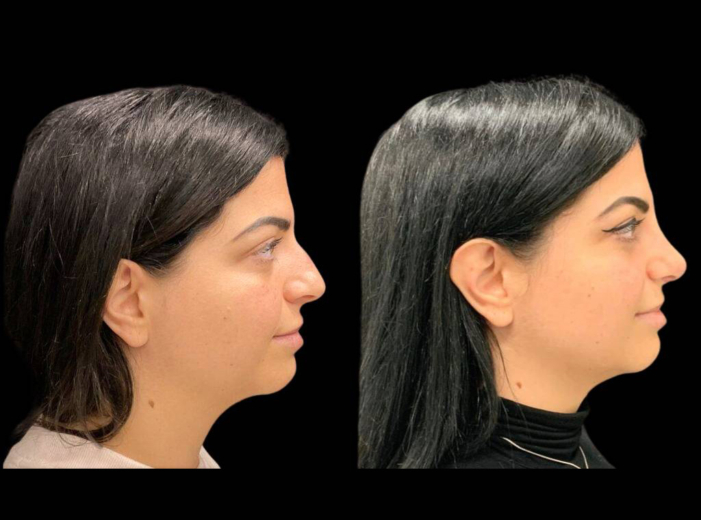 34-year-old-female-rhinoplasty-before-and-after-side-view.jpg