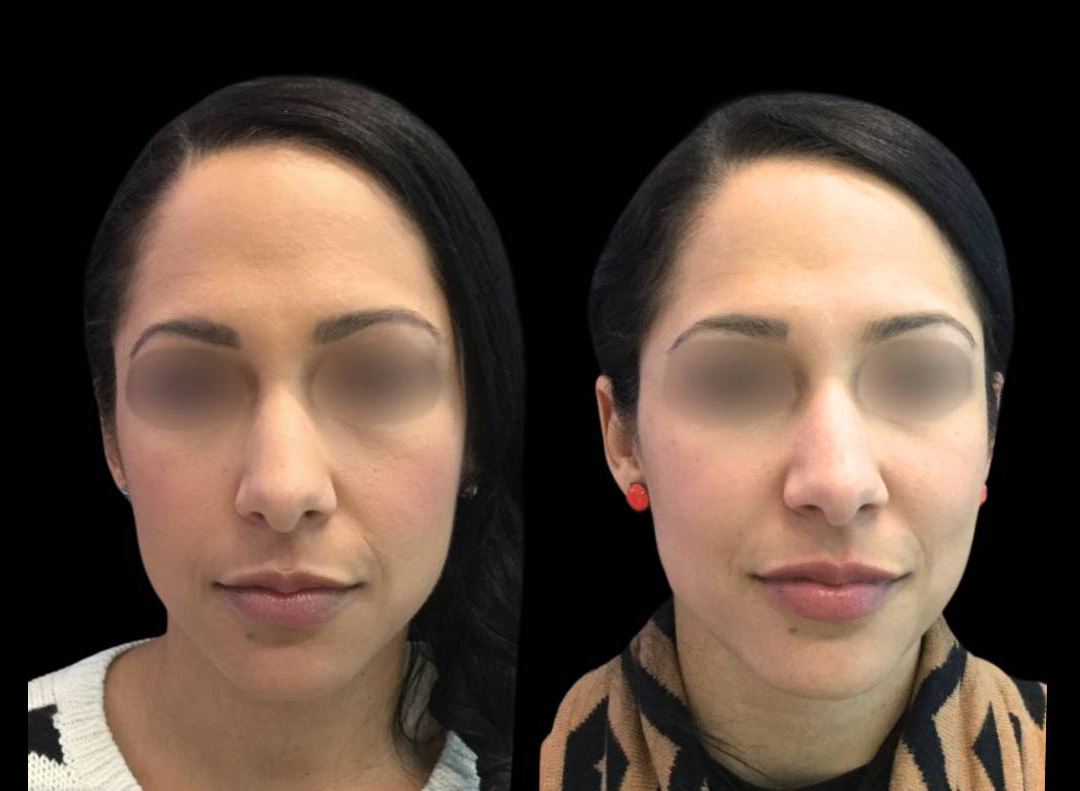34-year-old-female-voluma-before-and-after.jpg