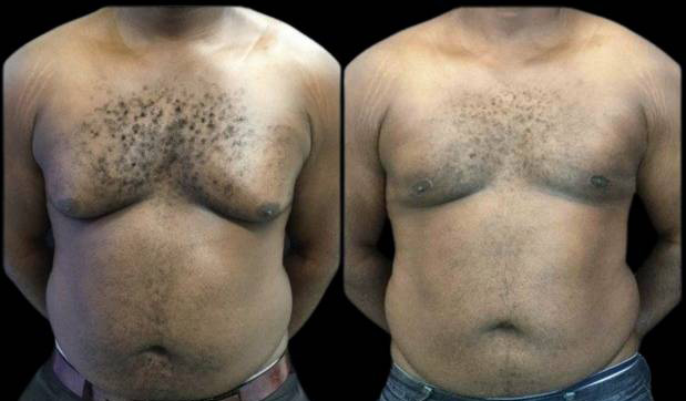34-year-old-male-breast-reduction-before-and-after-front-view-1.jpg