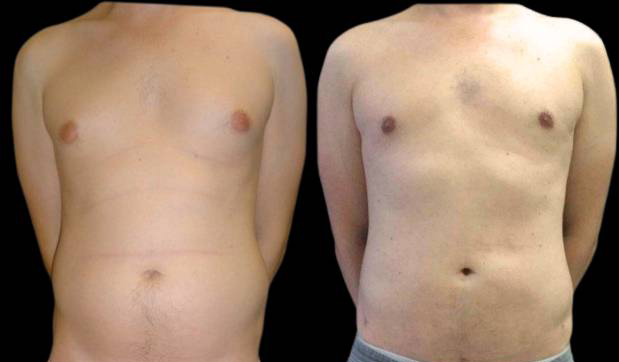 34-year-old-male-breast-reduction-before-and-after-front-view.jpg