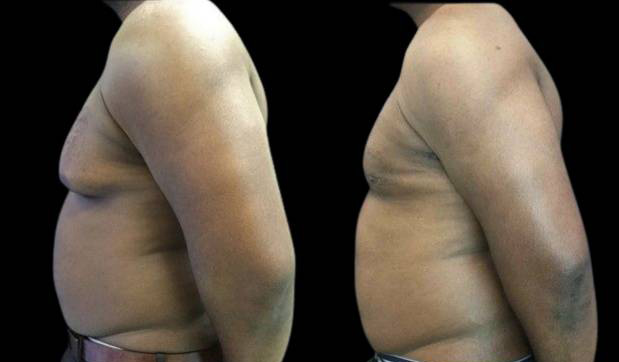 34-year-old-male-breast-reduction-before-and-after-side-view-0.jpg