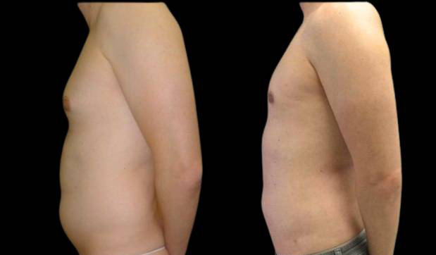 34-year-old-male-breast-reduction-before-and-after-side-view.jpg