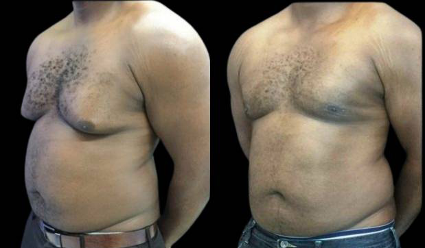 34-year-old-male-breast-reduction-before-and-after-three-quarter-view-1.jpg