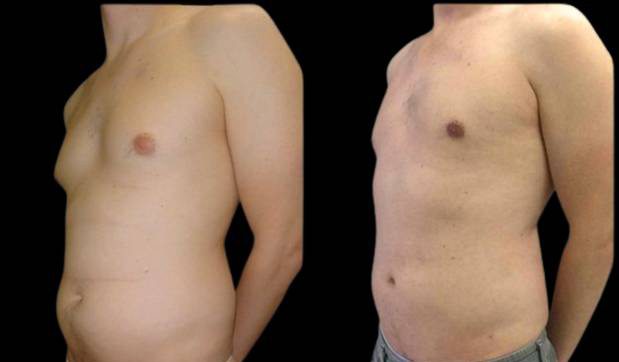 34-year-old-male-breast-reduction-before-and-after-three-quarter-view.jpg