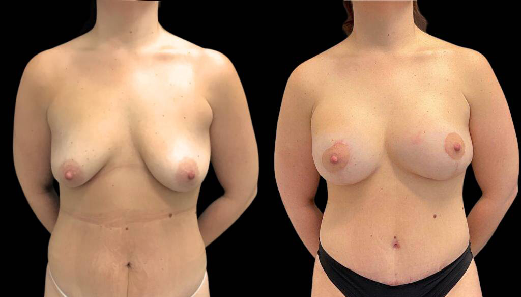 35-year-old-female-liposuction-before-and-after-front-view-34257.jpg