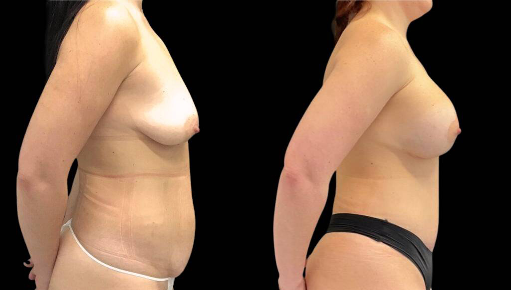 35-year-old-female-liposuction-before-and-after-side-view-1.jpg