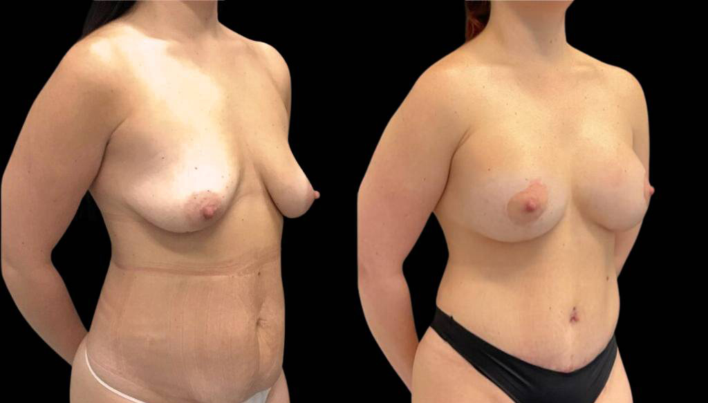 35-year-old-female-liposuction-before-and-after-three-quarter-view-1.jpg