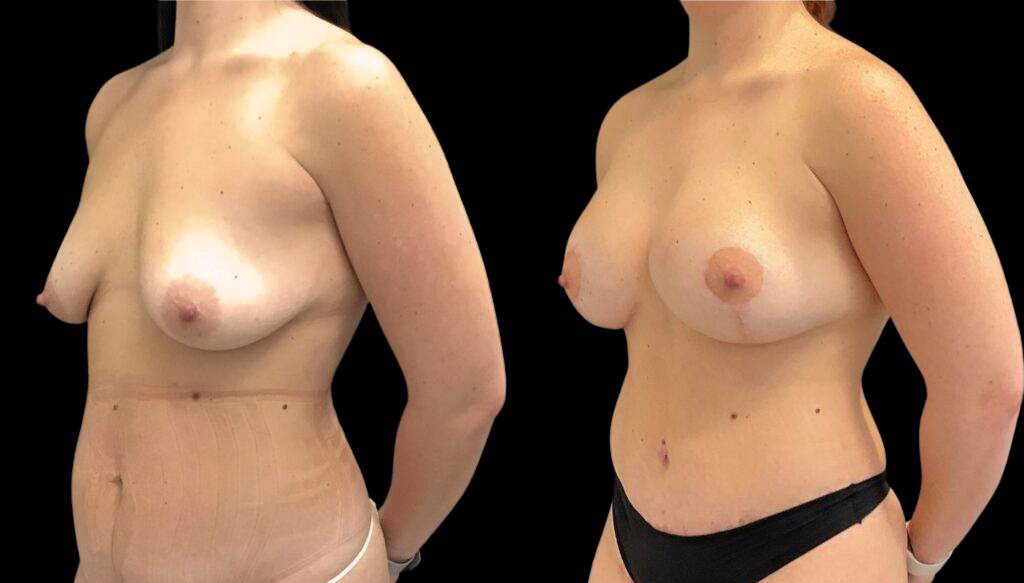35-year-old-female-liposuction-before-and-after-three-quarter-view-2-1.jpg