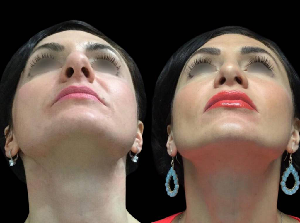 35-year-old-female-rhinoplasty-before-and-after-front-view-1.jpg