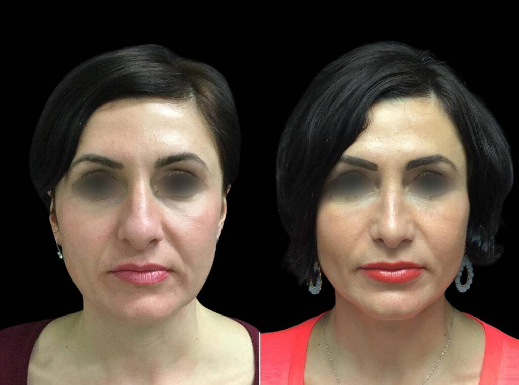 35-year-old-female-rhinoplasty-before-and-after-front-view.jpg