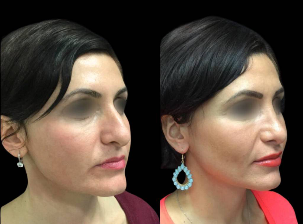 35-year-old-female-rhinoplasty-before-and-after-three-quarter-view.jpg