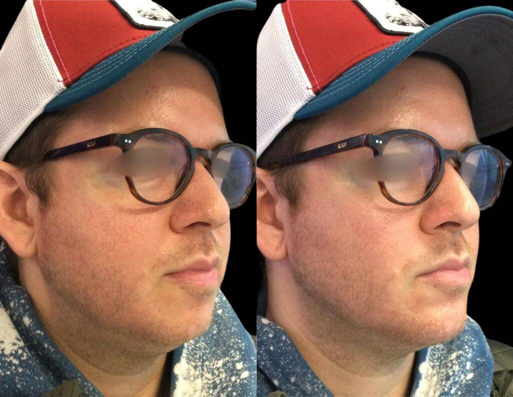 35-year-old-male-non-surgical-chin-augmentation-before-and-after-front-view.jpg