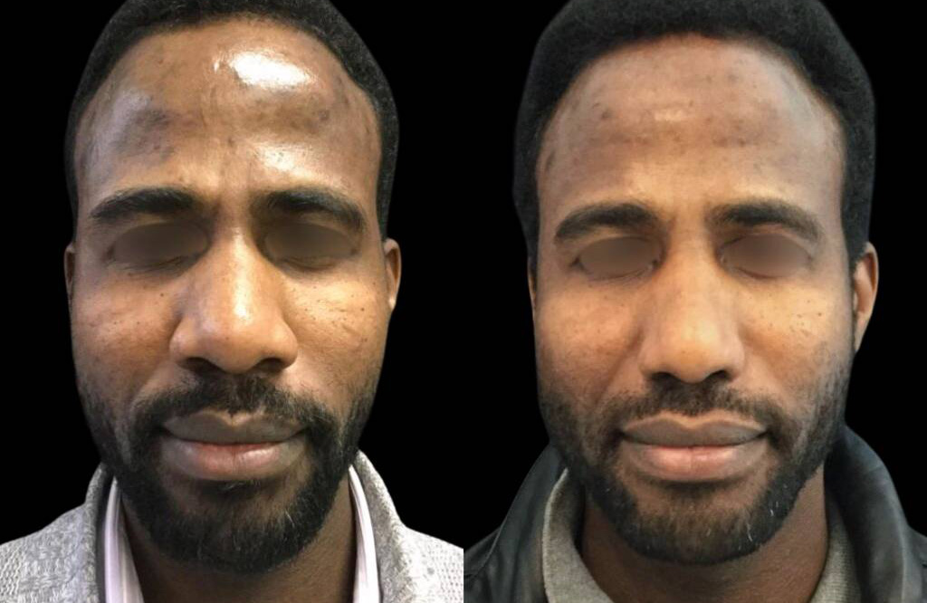 35-year-old-male-rhinoplasty-before-and-after-front-view.jpg