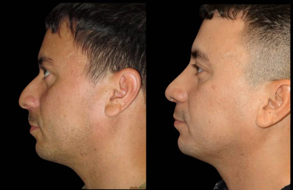 35-year-old-male-rhinoplasty-before-and-after-side-view-1.jpg