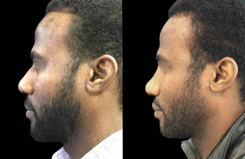35-year-old-male-rhinoplasty-before-and-after-side-view.jpg