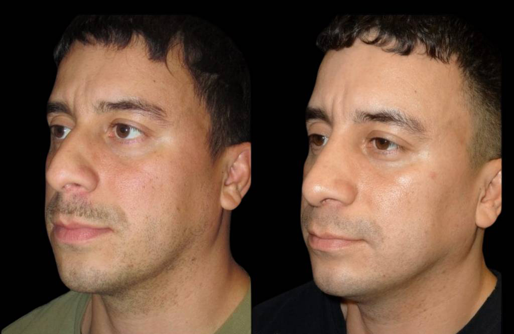 35-year-old-male-rhinoplasty-before-and-after-three-quarters-view-2.jpg