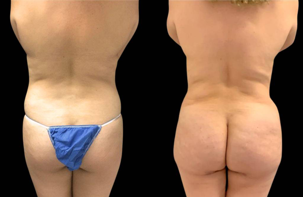 This is a 36-year-old female that has had a brazilian butt lift showing the before and after's side-by-side