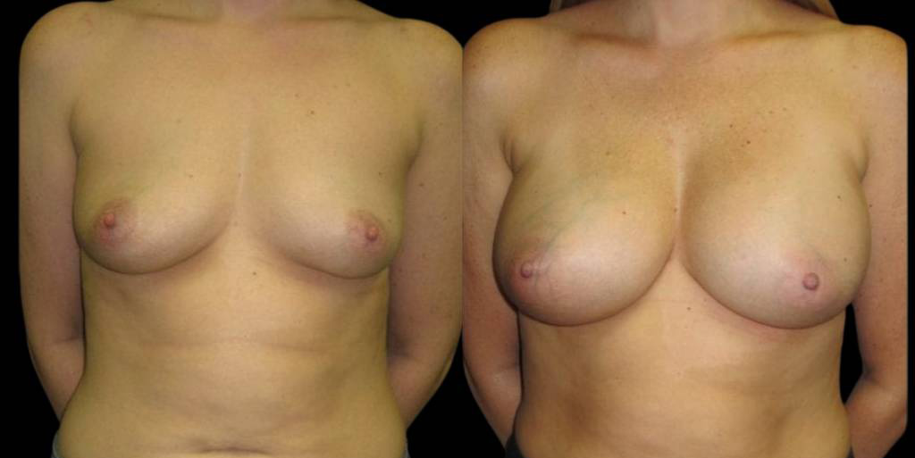 This is a 36-year-old female that has had a breast augmentation and implant showing the before and after's side-by-side
